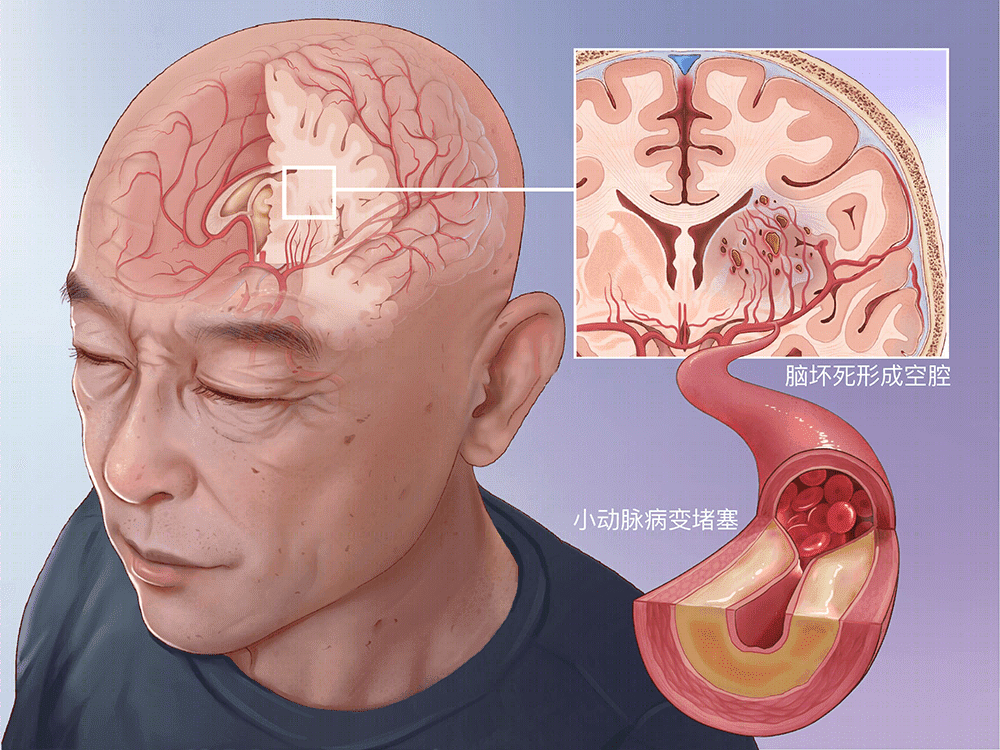 2026脑梗死高危人群必读的预防手册