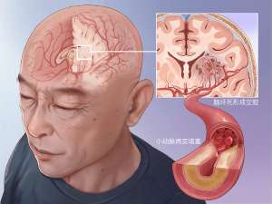 2026脑梗死高危人群必读的预防手册