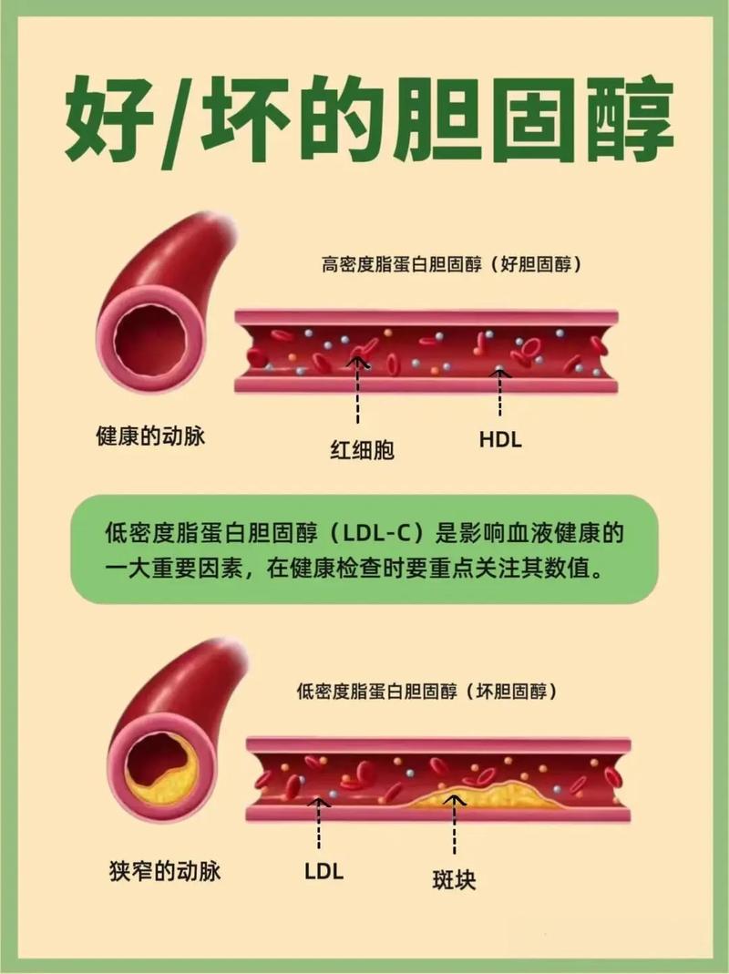 得了2026高血脂怎么办？分步应对策略