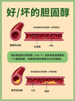 得了2026高血脂怎么办？分步应对策略